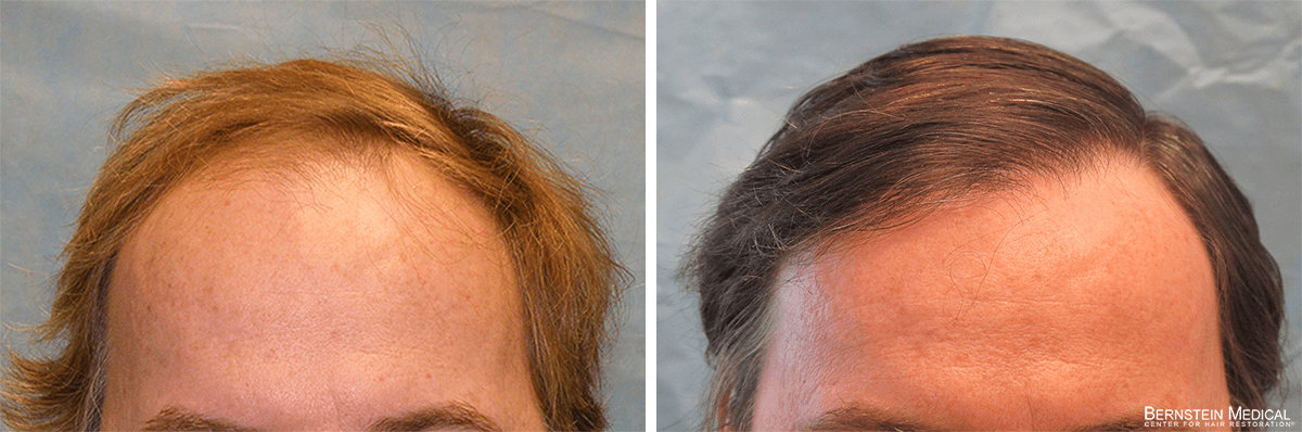 Bernstein Medical - Patient QRS Before and After Hair Transplant Photo 