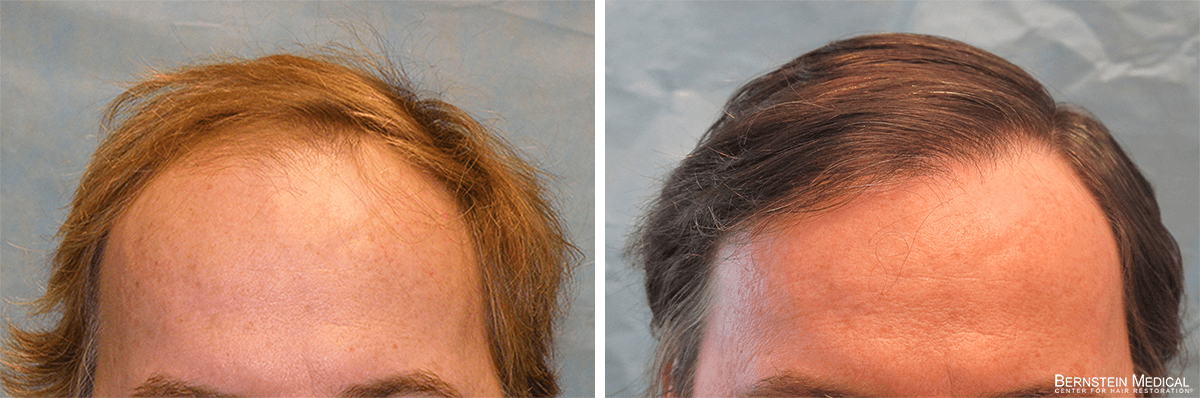 Bernstein Medical - Patient QRS Before and After Hair Transplant Photo