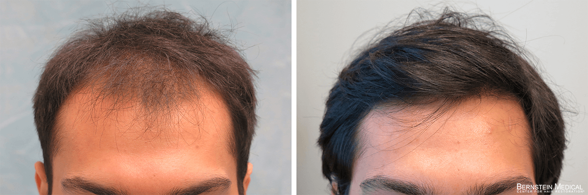 Bernstein Medical - Patient RBO Before and After Hair Transplant Photo 