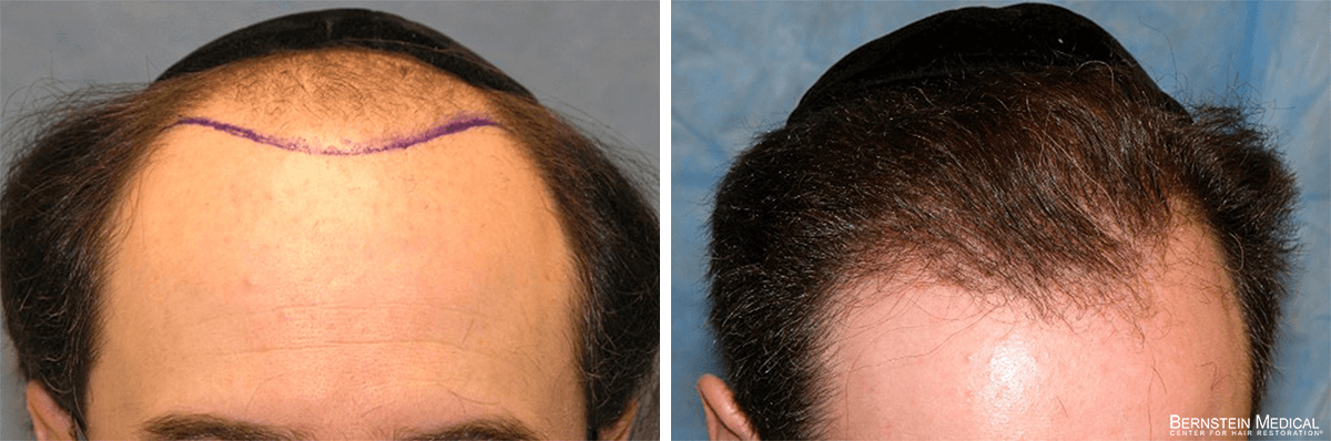 Bernstein Medical - Patient RBY Before and After Hair Transplant Photo 