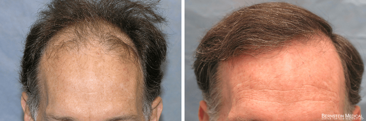 Bernstein Medical - Patient RCG Before and After Hair Transplant Photo 