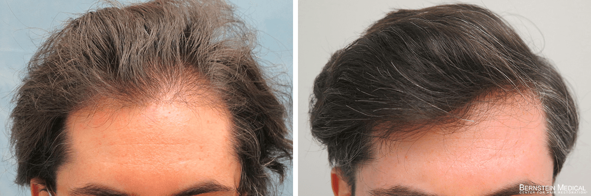 Bernstein Medical - Patient REI Before and After Hair Transplant Photo 