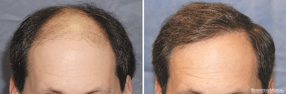Bernstein Medical - Patient RHK Before and After Hair Transplant Photo 