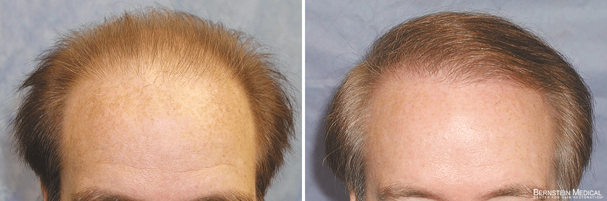 Bernstein Medical - Patient RKE Before and After Hair Transplant Photo 