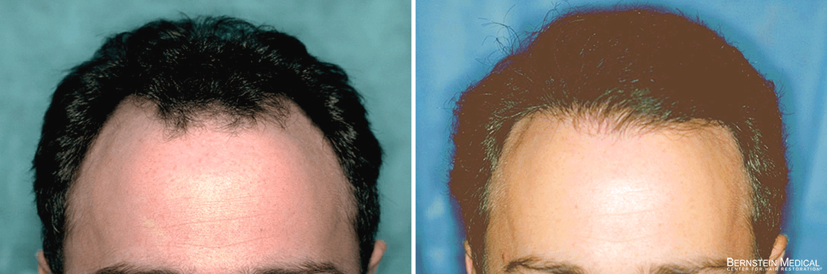Bernstein Medical - Patient RLC Before and After Hair Transplant Photo 