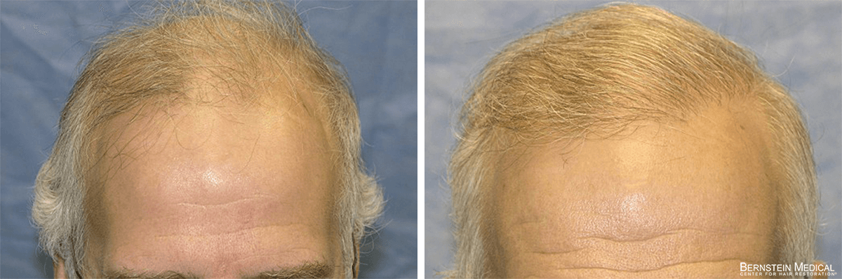 Bernstein Medical - Patient RMA Before and After Hair Transplant Photo 