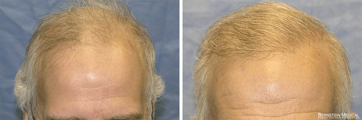 Bernstein Medical - Patient RMA Before and After Hair Transplant Photo