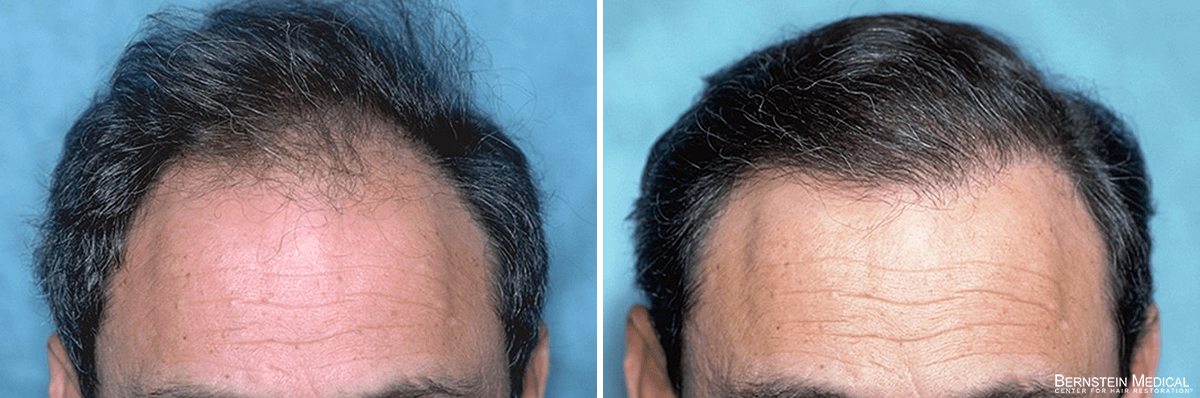 Bernstein Medical - Patient RMC Before and After Hair Transplant Photo 