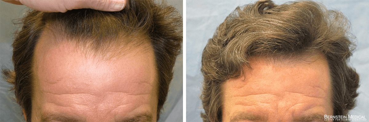 Bernstein Medical - Patient RMQ Before and After Hair Transplant Photo 