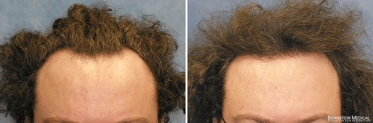 Bernstein Medical - Patient RNL Before and After Hair Transplant Photo
