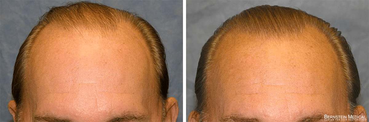 Bernstein Medical - Patient RTQ Before and After Hair Transplant Photo