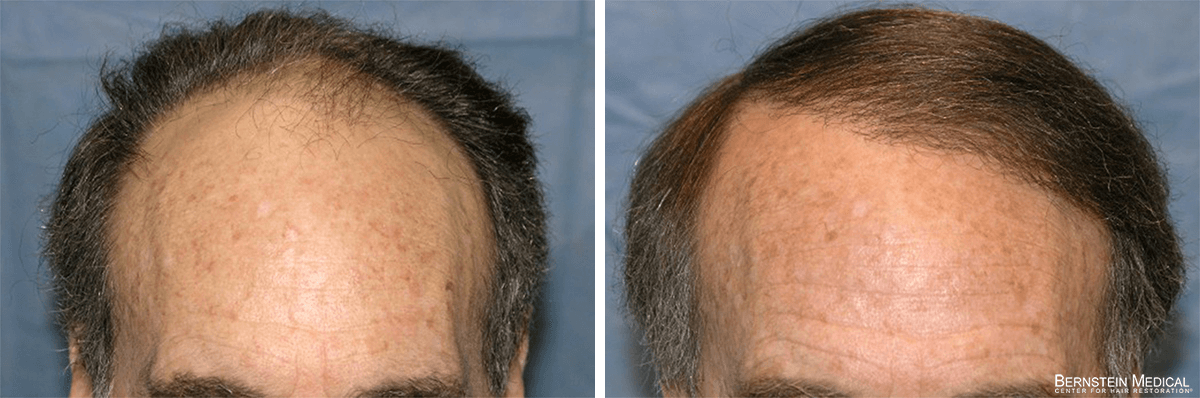 Bernstein Medical - Patient RZL Before and After Hair Transplant Photo 