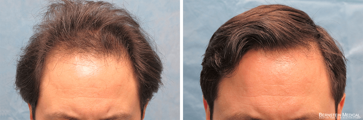 Bernstein Medical - Patient RZR Before and After Hair Transplant Photo 