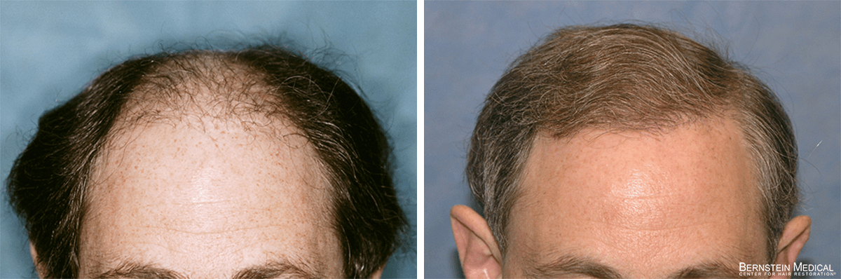 Bernstein Medical - Patient SNC Before and After Hair Transplant Photo 