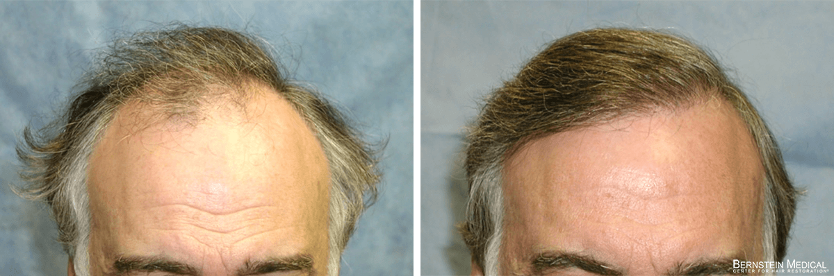 Bernstein Medical - Patient SOI Before and After Hair Transplant Photo 