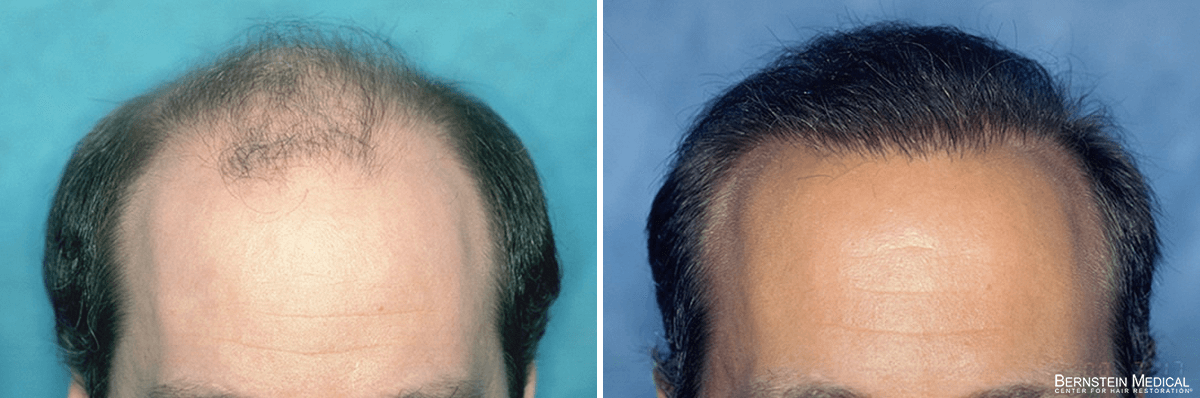 Bernstein Medical - Patient SPU Before and After Hair Transplant Photo 