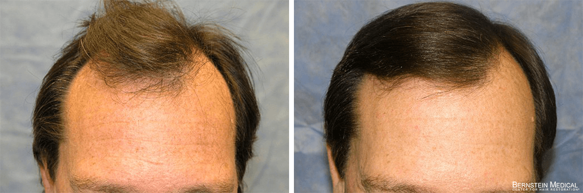 Bernstein Medical - Patient SWQ Before and After Hair Transplant Photo 