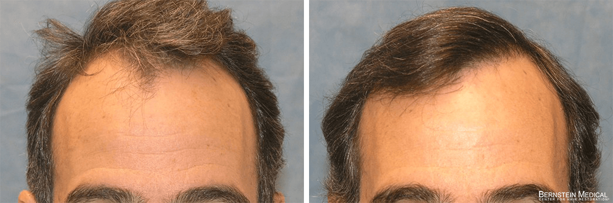Bernstein Medical - Patient UAI Before and After Hair Transplant Photo 