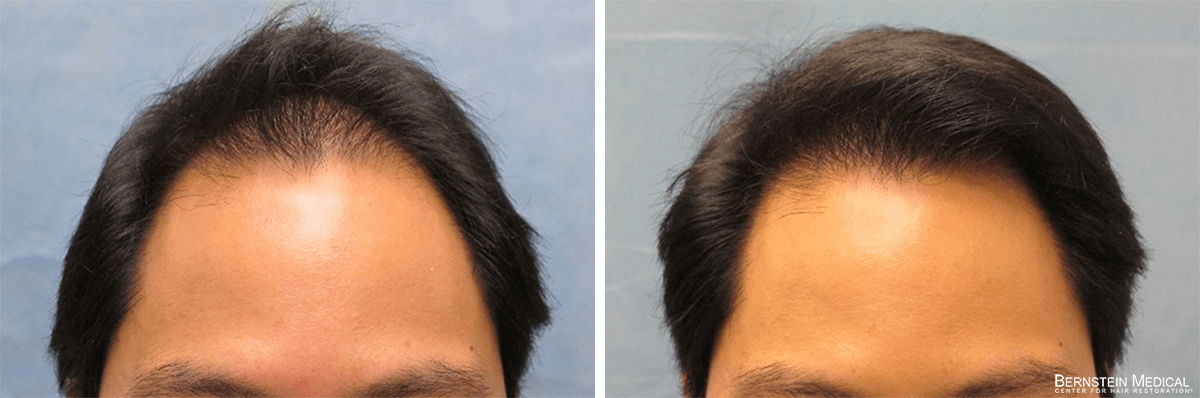 Bernstein Medical - Patient UFI Before and After Hair Transplant Photo 