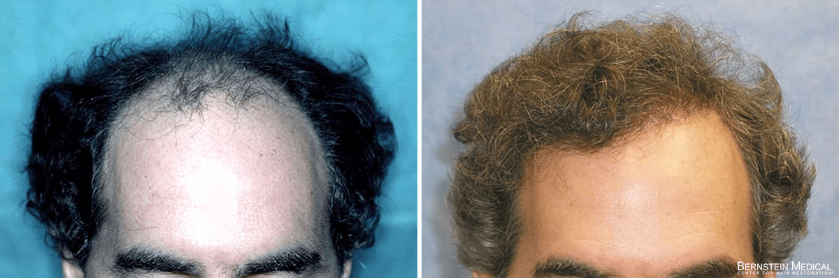 Bernstein Medical - Patient VQC Before and After Hair Transplant Photo 