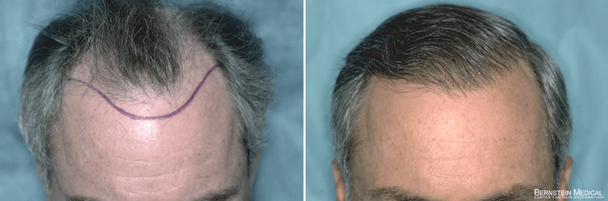 Bernstein Medical - Patient VRI Before and After Hair Transplant Photo 