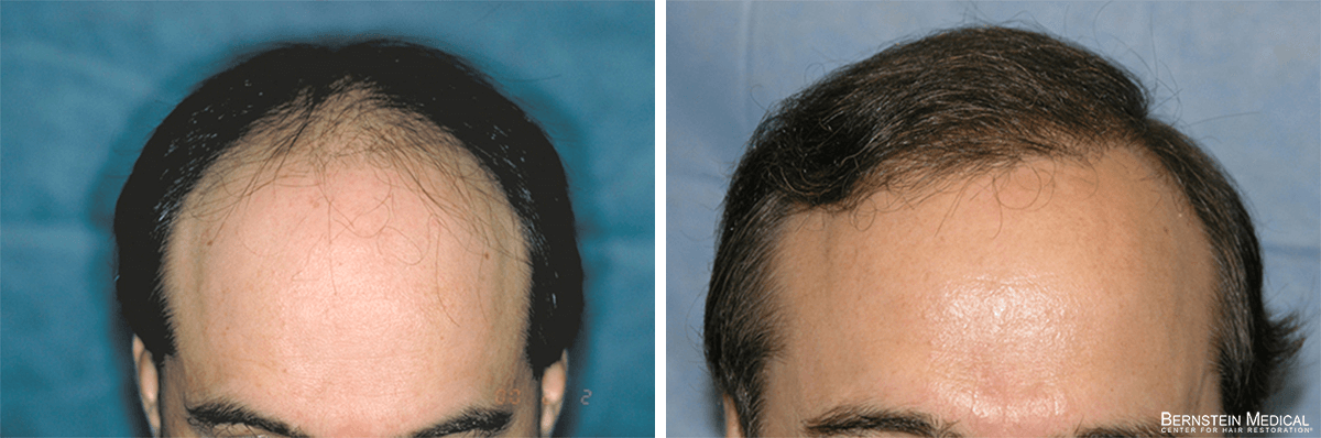 Bernstein Medical - Patient VSL Before and After Hair Transplant Photo 
