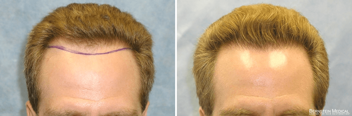 Bernstein Medical - Patient VSO Before and After Hair Transplant Photo 