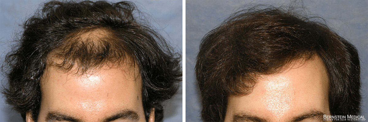 Bernstein Medical - Patient VUB Before and After Hair Transplant Photo 
