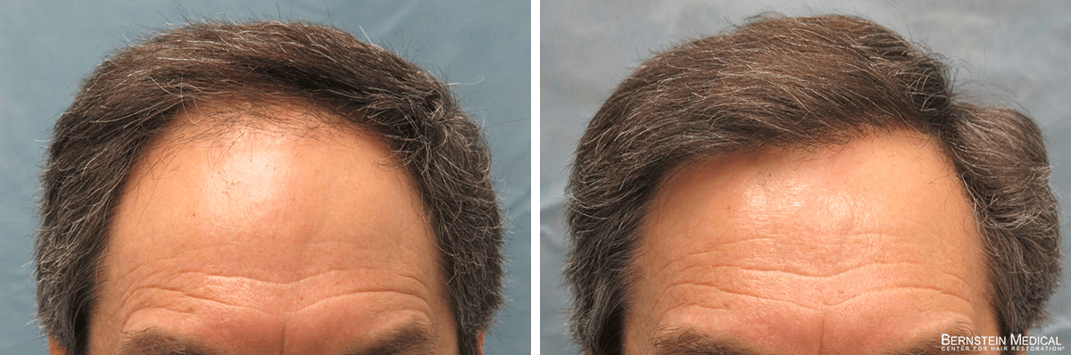 Bernstein Medical - Patient VWI Before and After Hair Transplant Photo
