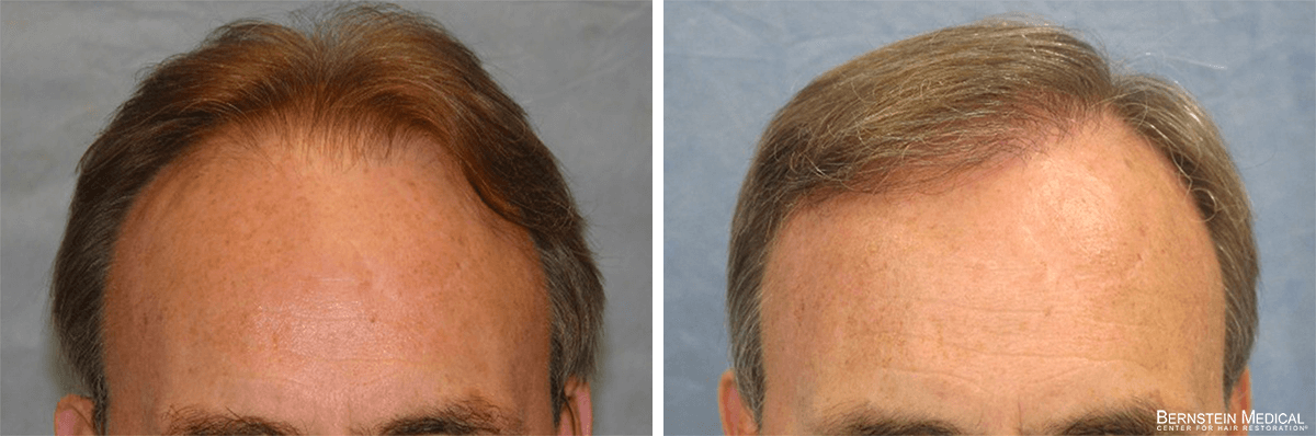 Bernstein Medical - Patient XCI Before and After Hair Transplant Photo