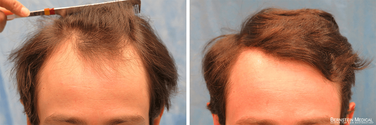Bernstein Medical - Patient ZQD Before and After Hair Transplant Photo 
