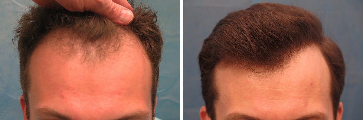 Bernstein Medical - Patient CPB Before and After Hair Transplant Photo 