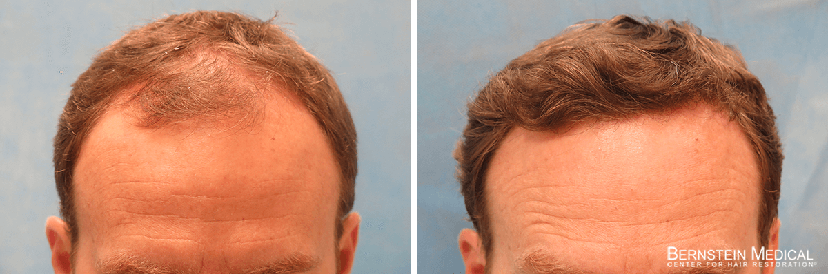 Bernstein Medical - Patient GPZ Before and After Hair Transplant Photo 