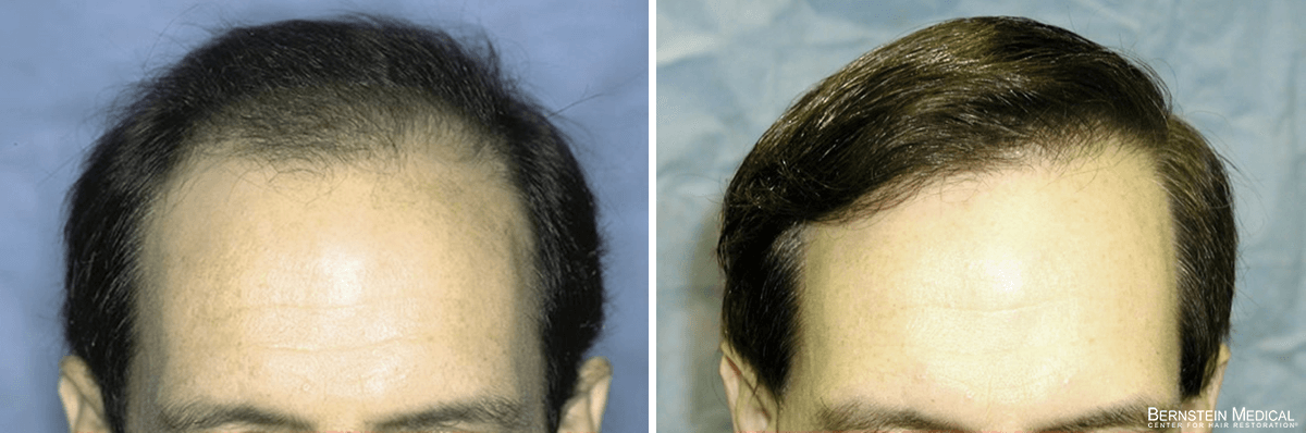 Bernstein Medical - Patient LYZ Before and After Hair Transplant Photo 