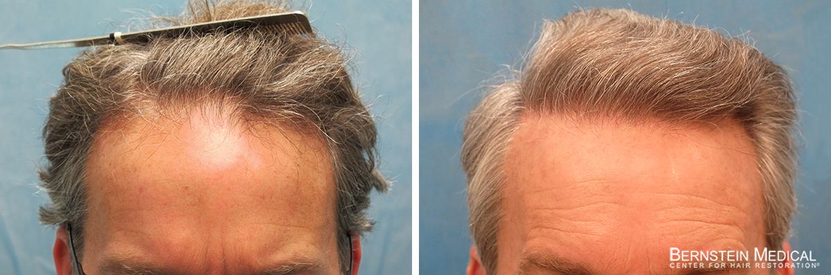 Bernstein Medical - Patient SVB Before and After Hair Transplant Photo 