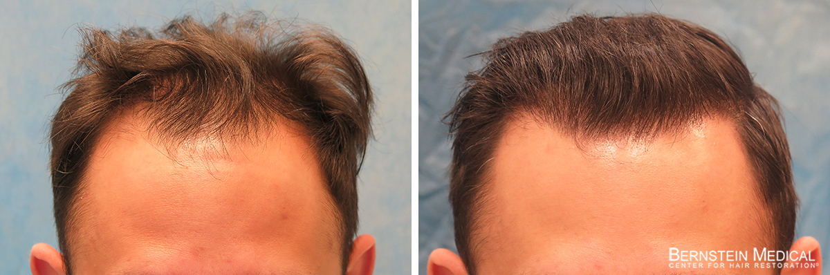 Bernstein Medical - Patient ZEI Before and After Hair Transplant Photo 