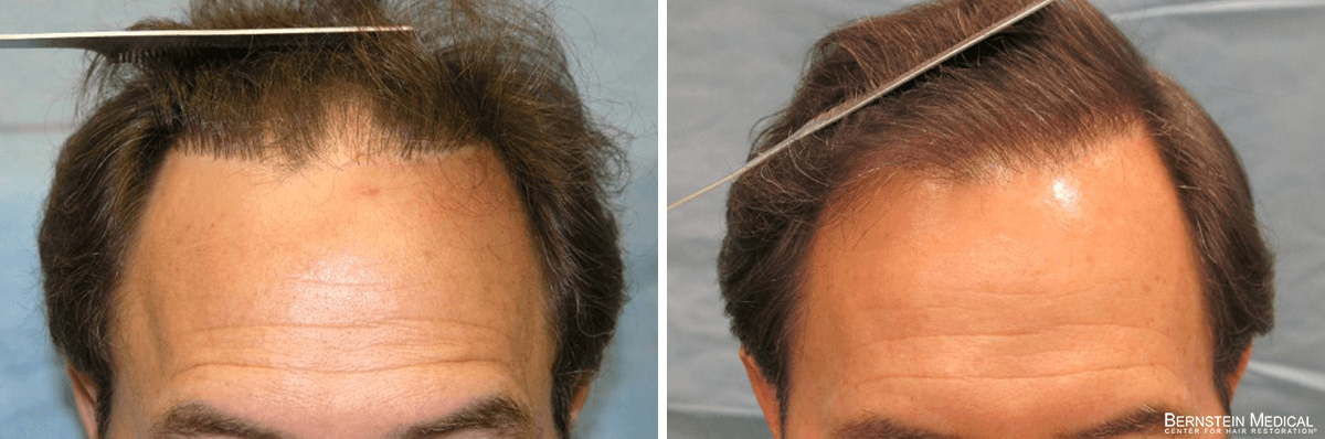 Bernstein Medical - Patient FEE Before and After Hair Transplant Photo 