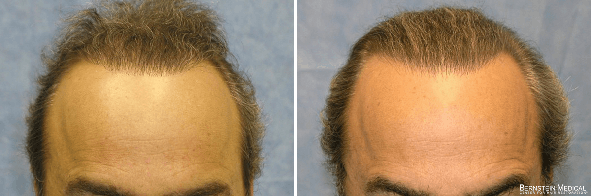 Bernstein Medical - Patient IJI Before and After Hair Transplant Photo 