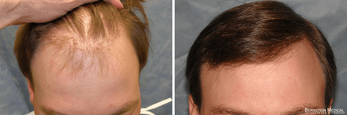 Bernstein Medical - Patient IKZ Before and After Hair Transplant Photo 
