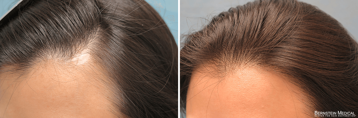 Bernstein Medical - Patient KSC Before and After Hair Transplant Photo 