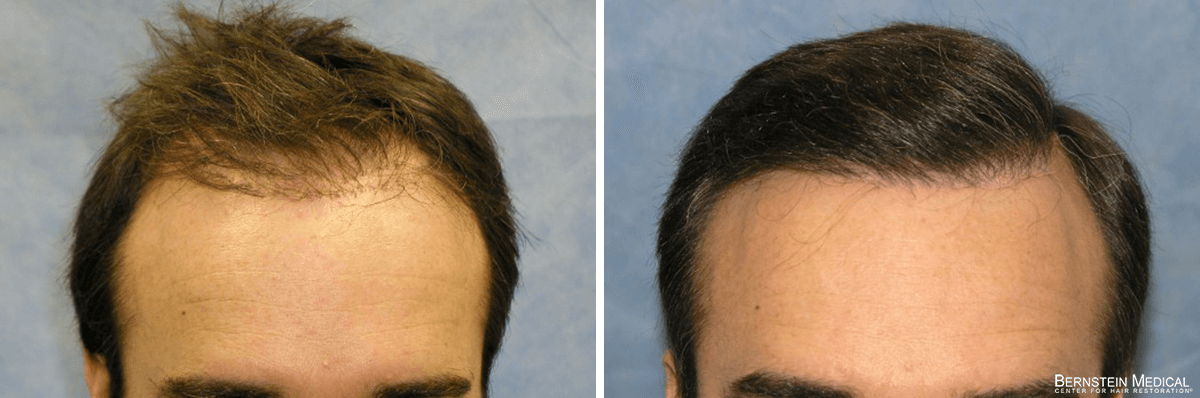 Bernstein Medical - Patient LHI Before and After Hair Transplant Photo 