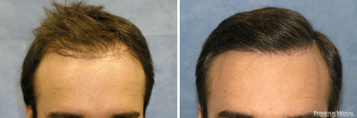 Bernstein Medical - Patient LHI Before and After Hair Transplant Photo