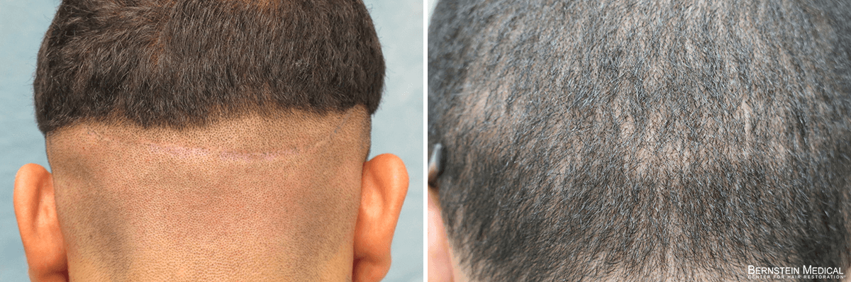 Bernstein Medical - Patient LRP Before and After Hair Transplant Photo 