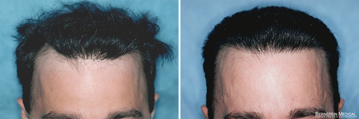 Bernstein Medical - Patient OLI Before and After Hair Transplant Photo 