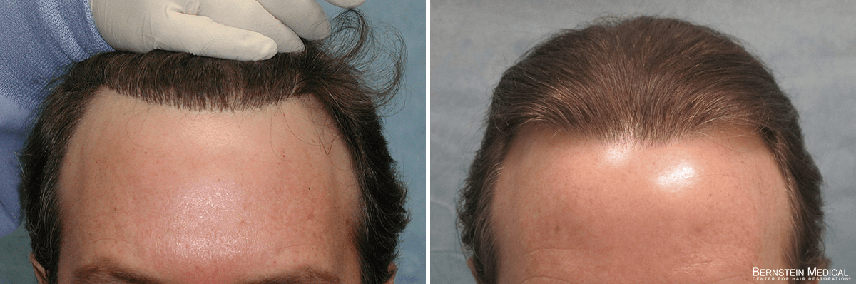 Bernstein Medical - Patient QEC Before and After Hair Transplant Photo 