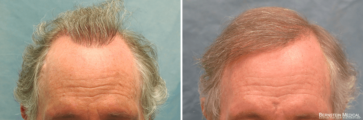 Bernstein Medical - Patient QOR Before and After Hair Transplant Photo 