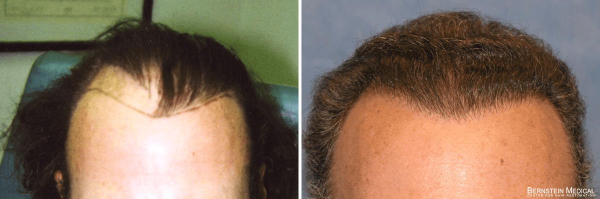 Bernstein Medical - Patient RGL Before and After Hair Transplant Photo 
