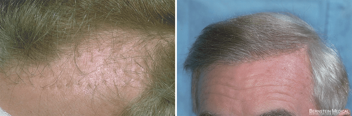Bernstein Medical - Patient ABQ Before and After Hair Transplant Photo 