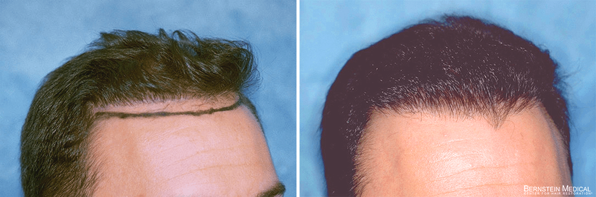 Bernstein Medical - Patient BDS Before and After Hair Transplant Photo 