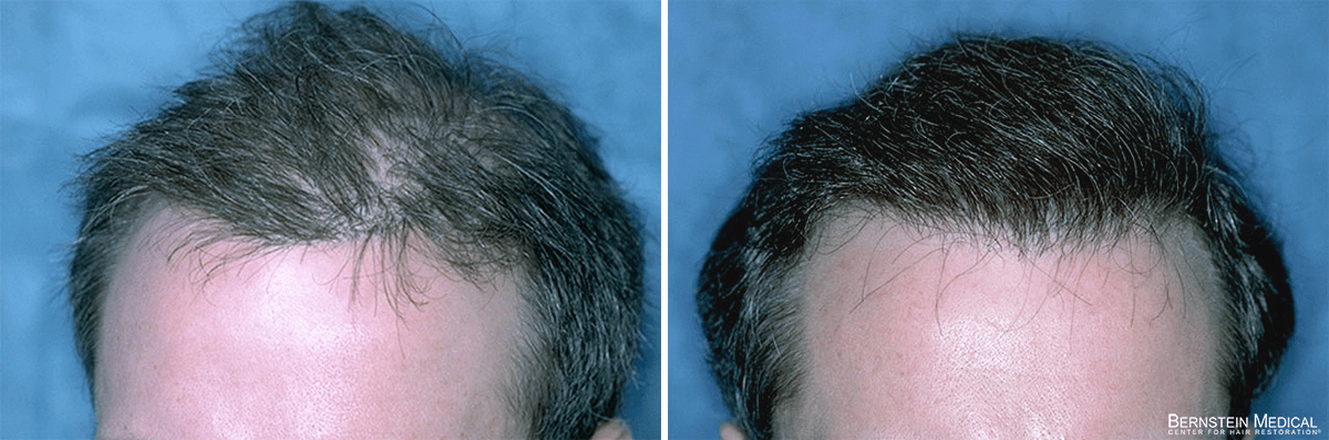 Bernstein Medical - Patient CFZ Before and After Hair Transplant Photo 